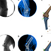 Panels A and B represent a single frame of the biplanar videoradiography data for source 1 and 2, respectively. Panels C and D represent the same frame of the biplanar videoradiography data (blue) after image processing. The 3-D models of the tibia and femur driven by optical motion capture (tan) and biplanar motion capture (blue) are shown in panels E and F. All four independently tracked anatomical coordinate systems are also shown. The short and lighter coordinate systems are being driven by OMC and the long and darker coordinate systems are being driven by biplanar videoradiography. The external markers for the thigh and shank are also shown in tan. Panel E represents the initial frame, where OMC and biplanar videoradiography are perfectly aligned. Panel F represents a frame where soft tissue artifact is affecting the OMC driven bones and coordinate systems.